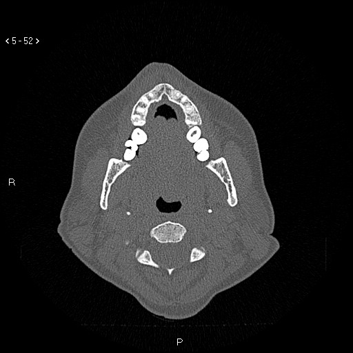 Nasolabial cyst (Radiopaedia 75125-86194 Axial bone window 13).jpg