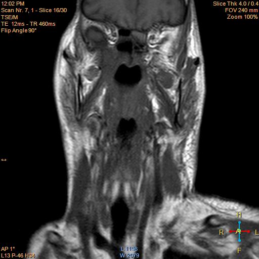File:Nasopharyngeal carcinoma (Radiopaedia 22375-22403 Coronal T1 7).jpg