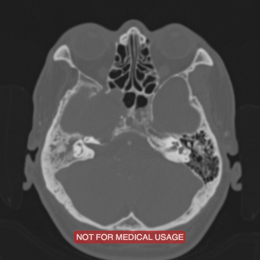 File:Nasopharyngeal carcinoma recurrence - skull base destruction (Radiopaedia 29107-29490 Axial bone window 81).jpg