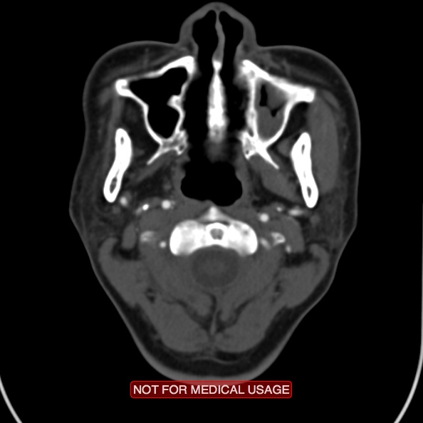 File:Nasopharyngeal carcinoma recurrence - skull base destruction (Radiopaedia 29107-29491 A 13).jpg