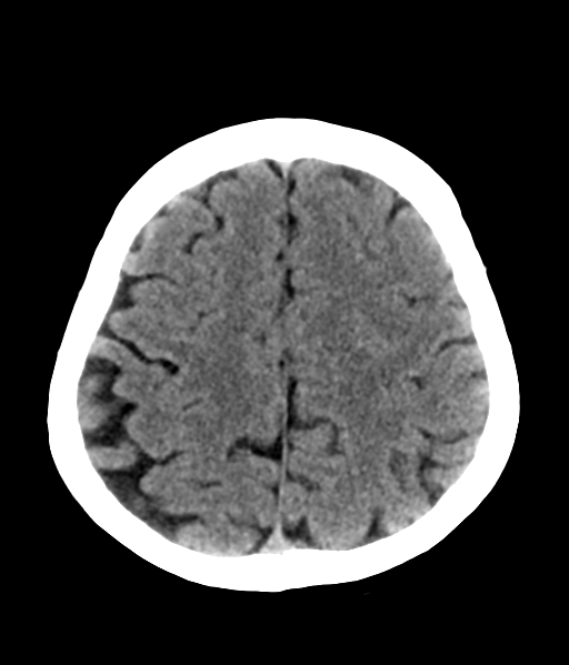 File:Nasopharyngeal carcinoma with cerebral abscess (Radiopaedia 43018-46275 Axial non-contrast 40).png