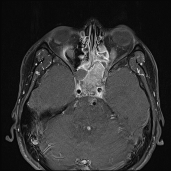 Nasopharyngeal carcinoma with skull base invasion (Radiopaedia 53415-59485 Axial T1 C+ fat sat 18).jpg