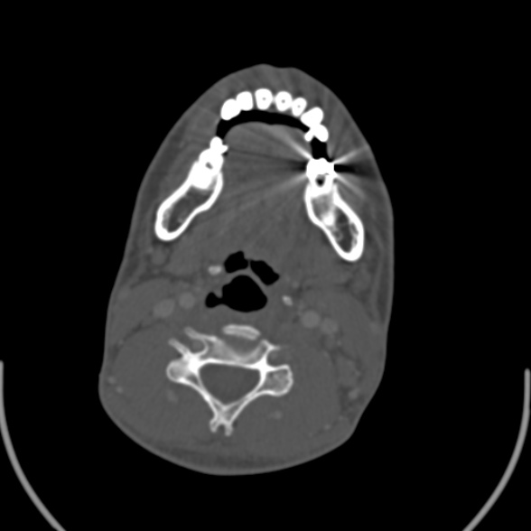 Nasopharyngeal carcinoma with skull base invasion (Radiopaedia 53415-59705 Axial bone window 119).jpg