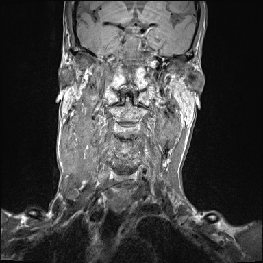 File:Nasopharyngeal carcinoma with skull base invasion (Radiopaedia 59258-66600 Coronal T1 15).jpg