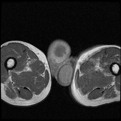 File:Necrotizing epididymo-orchitis with intra-testicular abscess (Radiopaedia 29397-29860 Axial T1 C+ 16).jpg