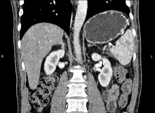 Necrotizing pancreatitis (Radiopaedia 87796-104248 F 42).jpg