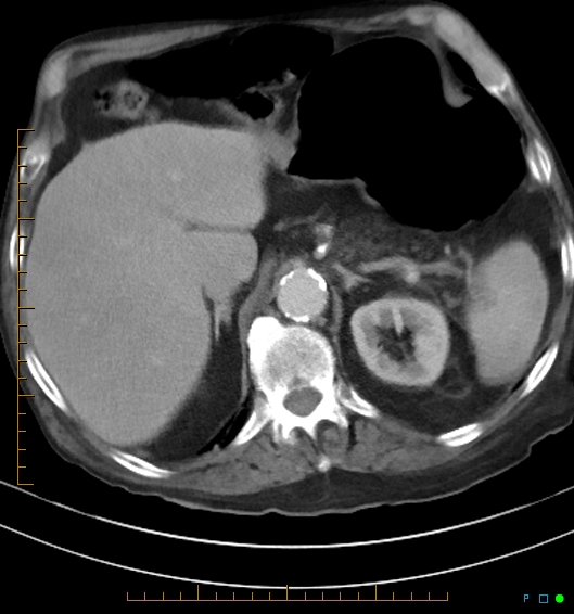Necrotzing fasciitis due to a perforated adenocarcinoma of the splenic flexure (Radiopaedia 46930-51455 A 21).jpg