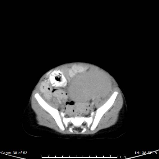 Nephroblastomatosis (Radiopaedia 41934-44935 A 38).jpg
