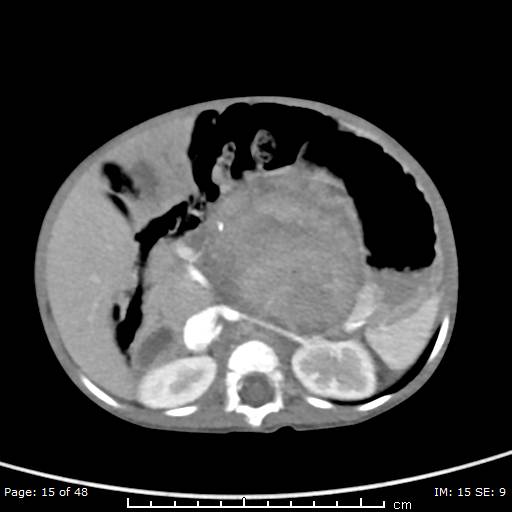 File:Neuroblastoma (Radiopaedia 41472-44355 A 15).jpg