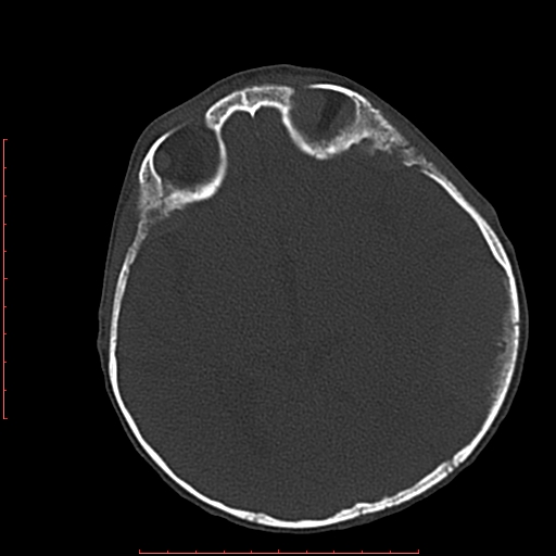 File:Neuroblastoma skull metastasis (Radiopaedia 56053-62683 Axial bone window 13).jpg