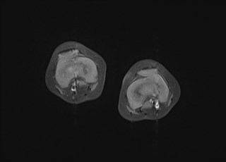 File:Neuroblastoma with bone metastases (Radiopaedia 67080-76414 Axial T1 C+ fat sat 8).jpg