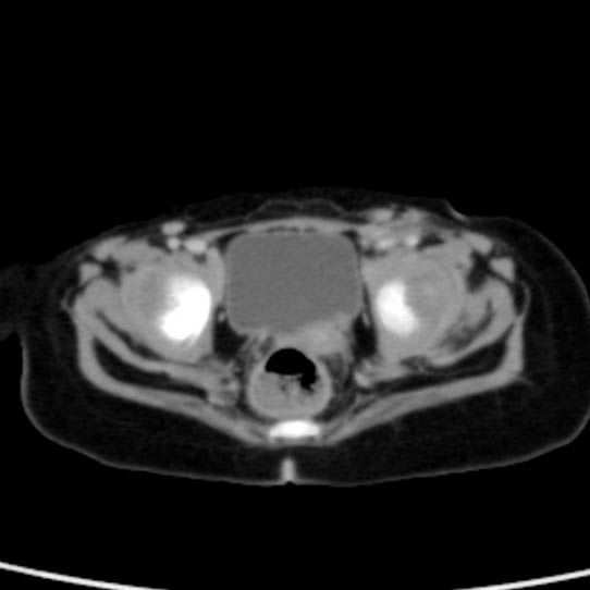 Neuroblastoma with skull metastases (Radiopaedia 30326-30960 C 57).jpg