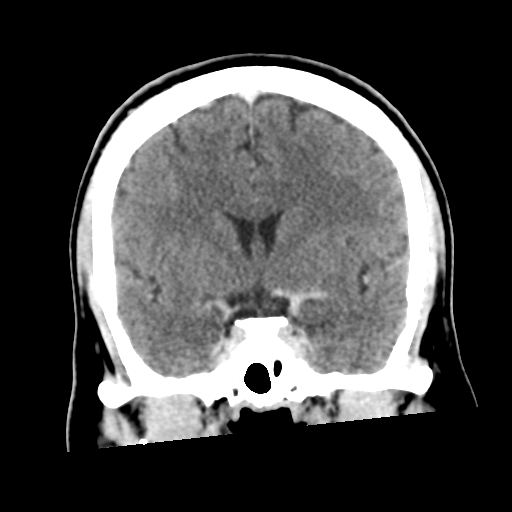 Neurocysticercosis - granular nodular (Radiopaedia 42786-45957 Coronal C+ 29).png