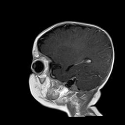 File:Neurofibromatosis type 1 (Radiopaedia 30089-30671 Sagittal T1 C+ 15).jpg