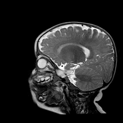 File:Neurofibromatosis type 1 (Radiopaedia 30089-30671 Sagittal T2 5).jpg