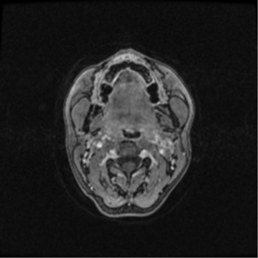 Neurofibromatosis type 2 (Radiopaedia 45229-49244 Axial T1 C+ 3).png
