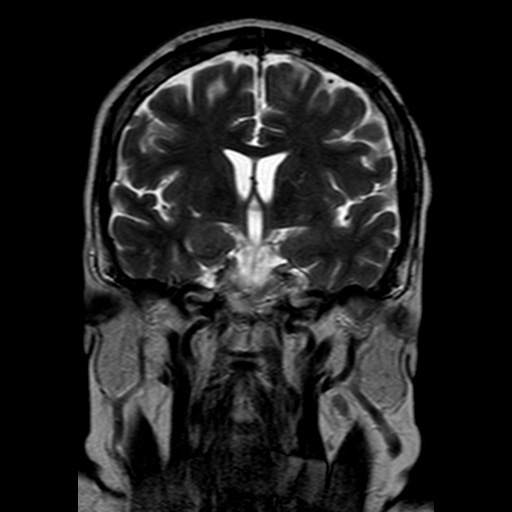 File:Neurofibromatosis type 2 (Radiopaedia 8713-9518 Coronal T2 11).jpg