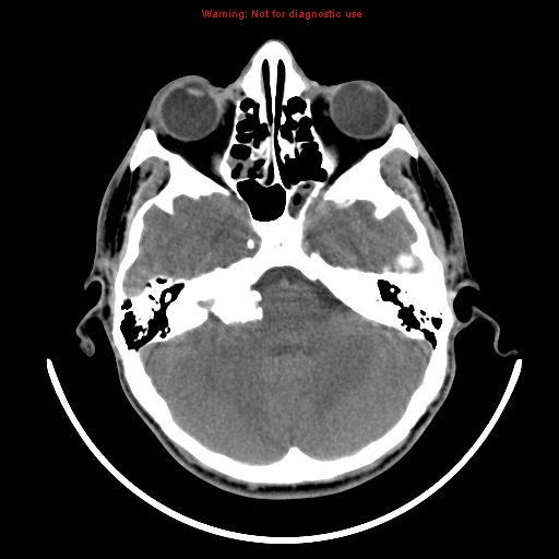 File:Neurofibromatosis type 2 (Radiopaedia 8953-9732 Axial non-contrast 8).jpg