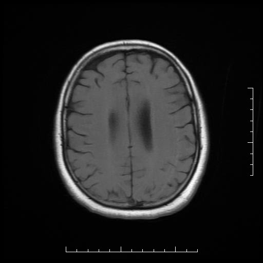 File:Neuroglial cyst of brainstem (Radiopaedia 29134-29526 Axial T1 15).jpg
