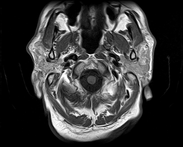 File:Non-Hodgkin lymphoma - parotid gland (Radiopaedia 71531-81890 Axial T1 17).jpg