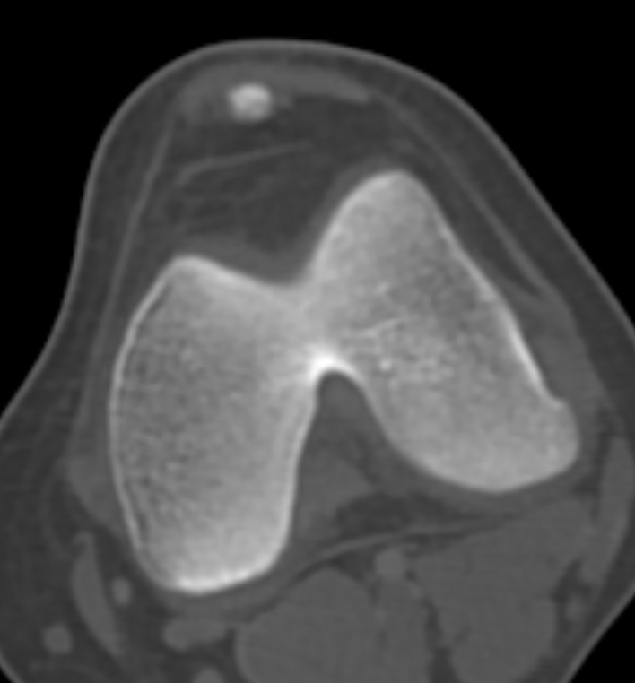 Non-ossifying fibroma - femur (Radiopaedia 82786-97042 Axial bone window 57).jpg
