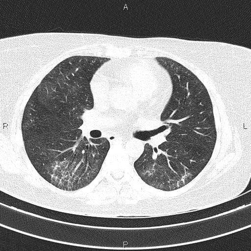 Non-specific interstitial pneumonia (Radiopaedia 83185-97567 Axial lung window 33).jpg