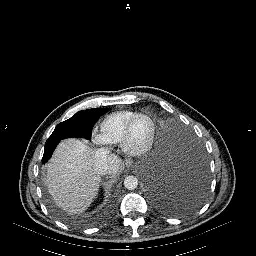 File:Non Hodgkin lymphoma in a patient with ankylosing spondylitis (Radiopaedia 84323-99621 B 26).jpg