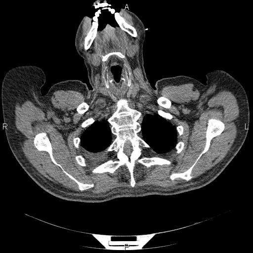 File:Non Hodgkin lymphoma in a patient with ankylosing spondylitis (Radiopaedia 84323-99624 Axial non-contrast 5).jpg
