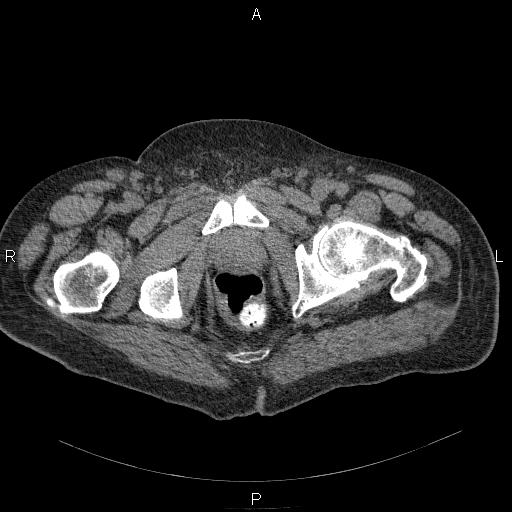 File:Non Hodgkin lymphoma in a patient with ankylosing spondylitis (Radiopaedia 84323-99624 Axial non-contrast 66).jpg