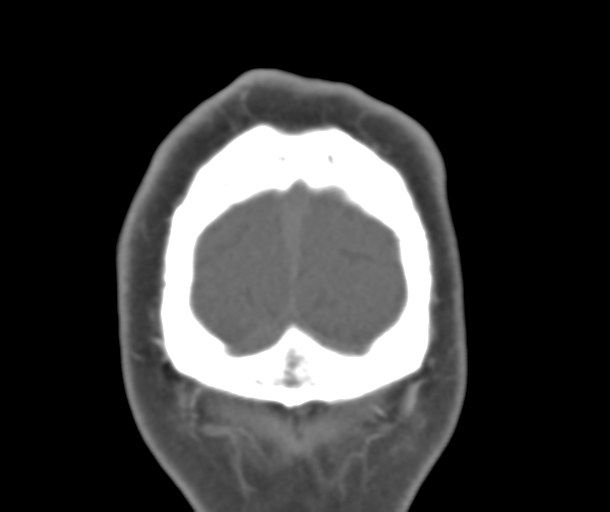 File:Normal CTA head (Radiopaedia 40801-43464 B 92).png