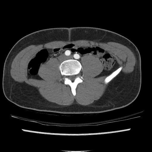 File:Normal CT angiogram of pelvis (Radiopaedia 45390-49430 A 16).jpg