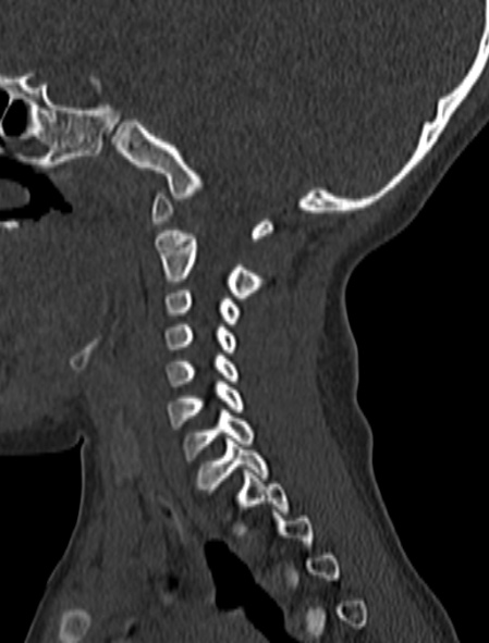 Normal CT cervical spine - pediatric (Radiopaedia 52549-58462 Sagittal bone window 145).jpg