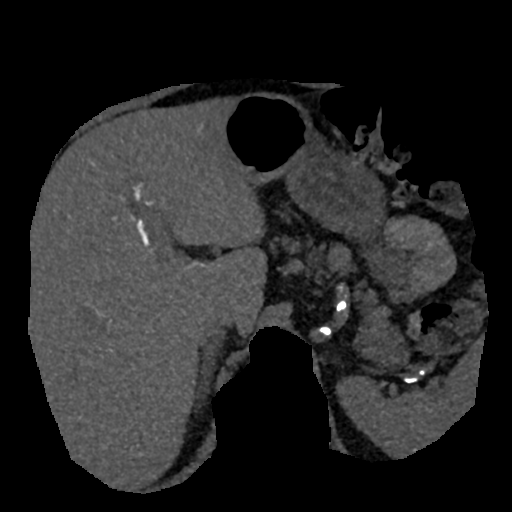 File:Normal CT intravenous cholangiogram (Radiopaedia 38199-40208 Axial IVC (MIP) 61).png