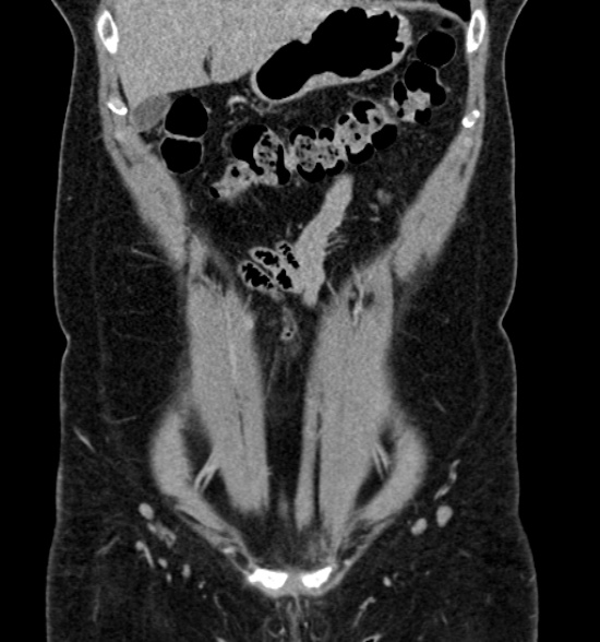 Normal CT intravenous urogram (Radiopaedia 39444-41759 A 196).jpg