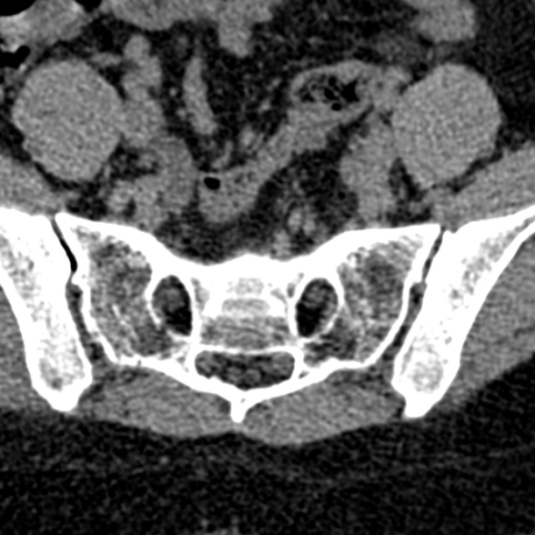 Normal CT lumbar spine (Radiopaedia 53981-60118 Axial non-contrast 98).jpg