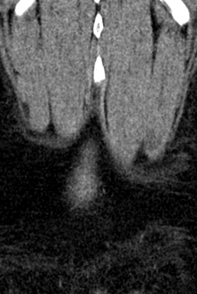 Normal CT lumbar spine (Radiopaedia 53981-60118 F 103).jpg