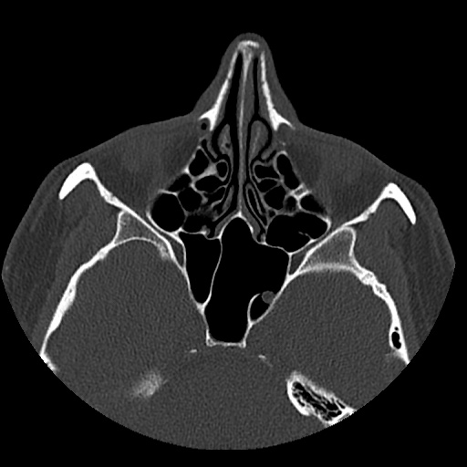 Normal CT paranasal sinuses (Radiopaedia 42286-45390 Axial bone window 56).jpg
