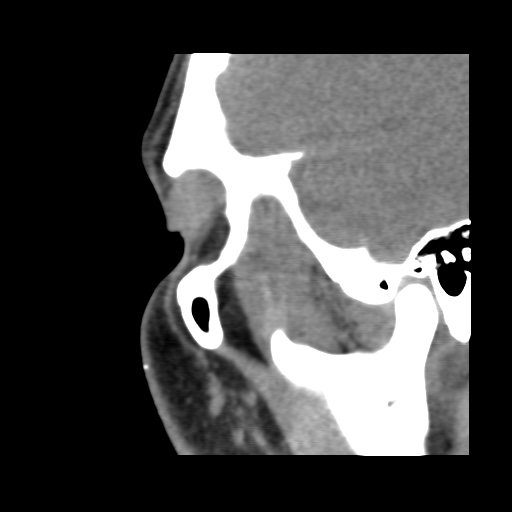 Normal CT paranasal sinuses (Radiopaedia 42286-45390 F 33).jpg
