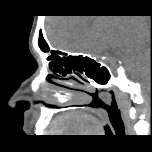 Normal CT paranasal sinuses (Radiopaedia 42286-45390 F 87).jpg