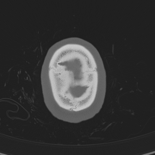 Normal CT skull (Radiopaedia 40798-43459 A 148).png