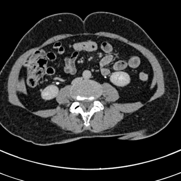 File:Normal CT split bolus study of the renal tract (Radiopaedia 48631-53634 Axial split bolus 150).jpg