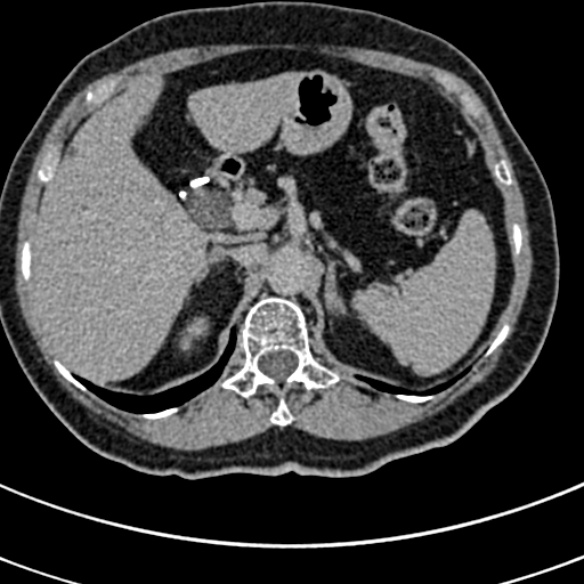 File:Normal CT split bolus study of the renal tract (Radiopaedia 48631-53634 Axial split bolus 20).jpg