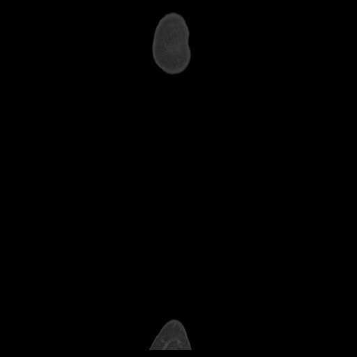 Normal CT tibia and fibula (Radiopaedia 51195-56848 Coronal non-contrast 9).jpg