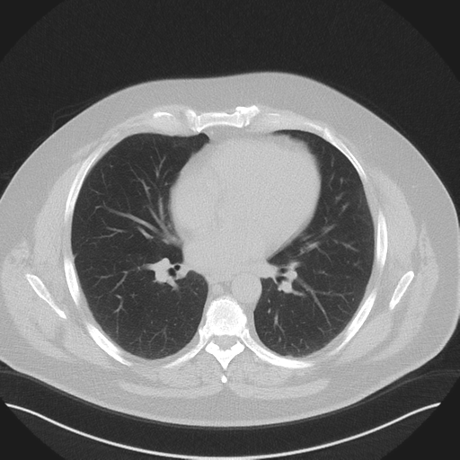 Normal HRCT (Radiopaedia 40797-43458 Axial lung window 33).png