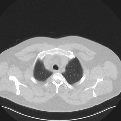 Normal HRCT (Radiopaedia 40797-43458 Axial lung window 9).png