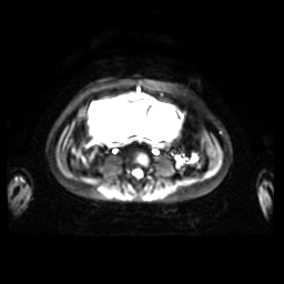 Normal MRI abdomen in pregnancy (Radiopaedia 88001-104541 Axial DWI 22).jpg