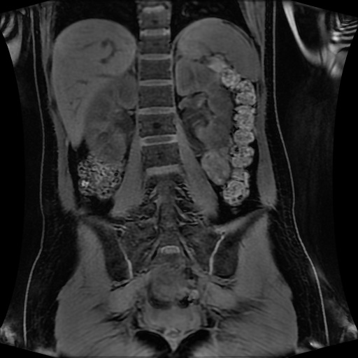 Normal MRI abdomen in pregnancy (Radiopaedia 88001-104541 M 93).jpg
