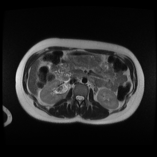 Normal MRI abdomen in pregnancy (Radiopaedia 88003-104546 Axial T2 12).jpg