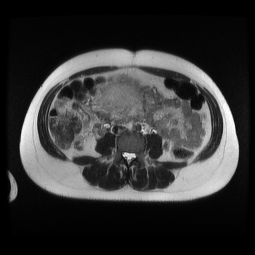 Normal MRI abdomen in pregnancy (Radiopaedia 88003-104546 Axial T2 22).jpg