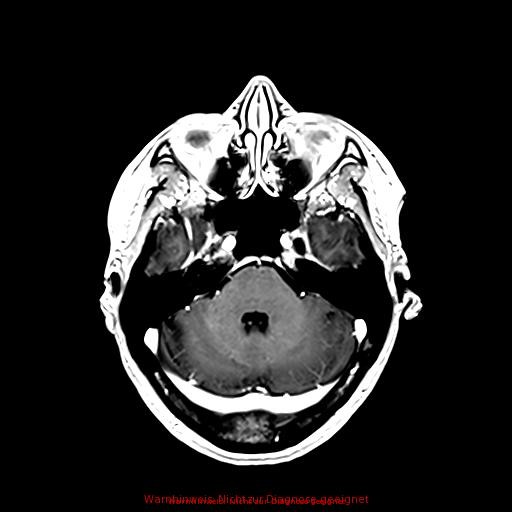 Normal adult brain MRI (non-enhanced and contrast-enhanced) (Radiopaedia 75262-86379 Axial T1 C+ 72).jpg